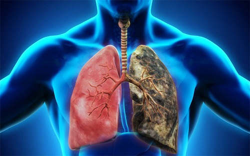 Bệnh ung thư phổi